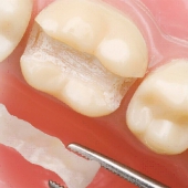 Traitement dentaire restaurateur